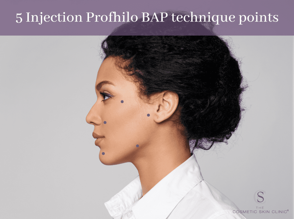 profhilo bap technique injecting points