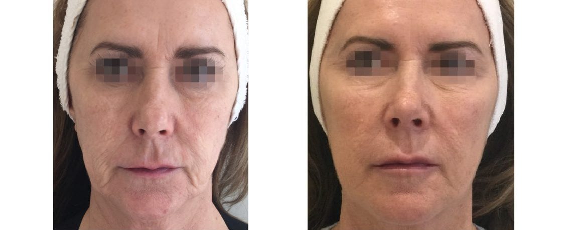 Profhilo Face Before and After