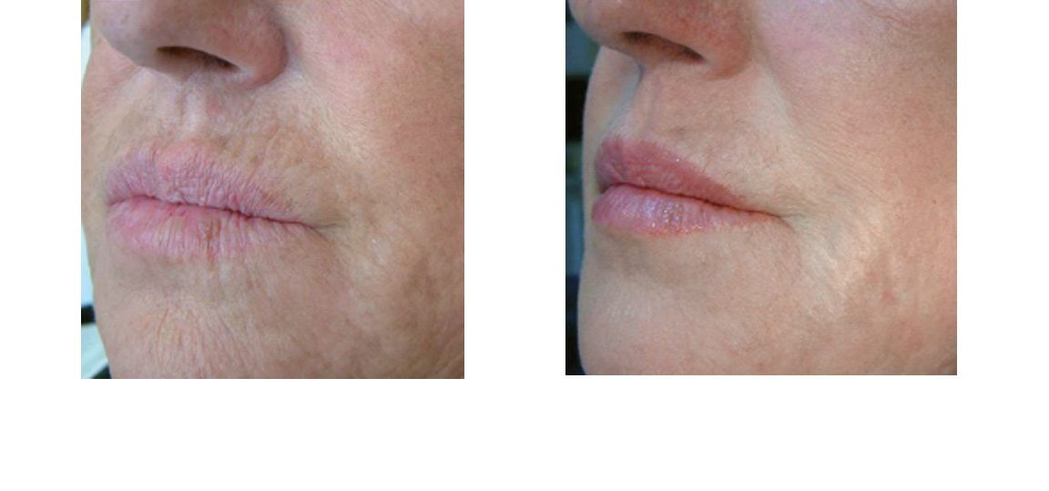 Profhilo Lips Before and after