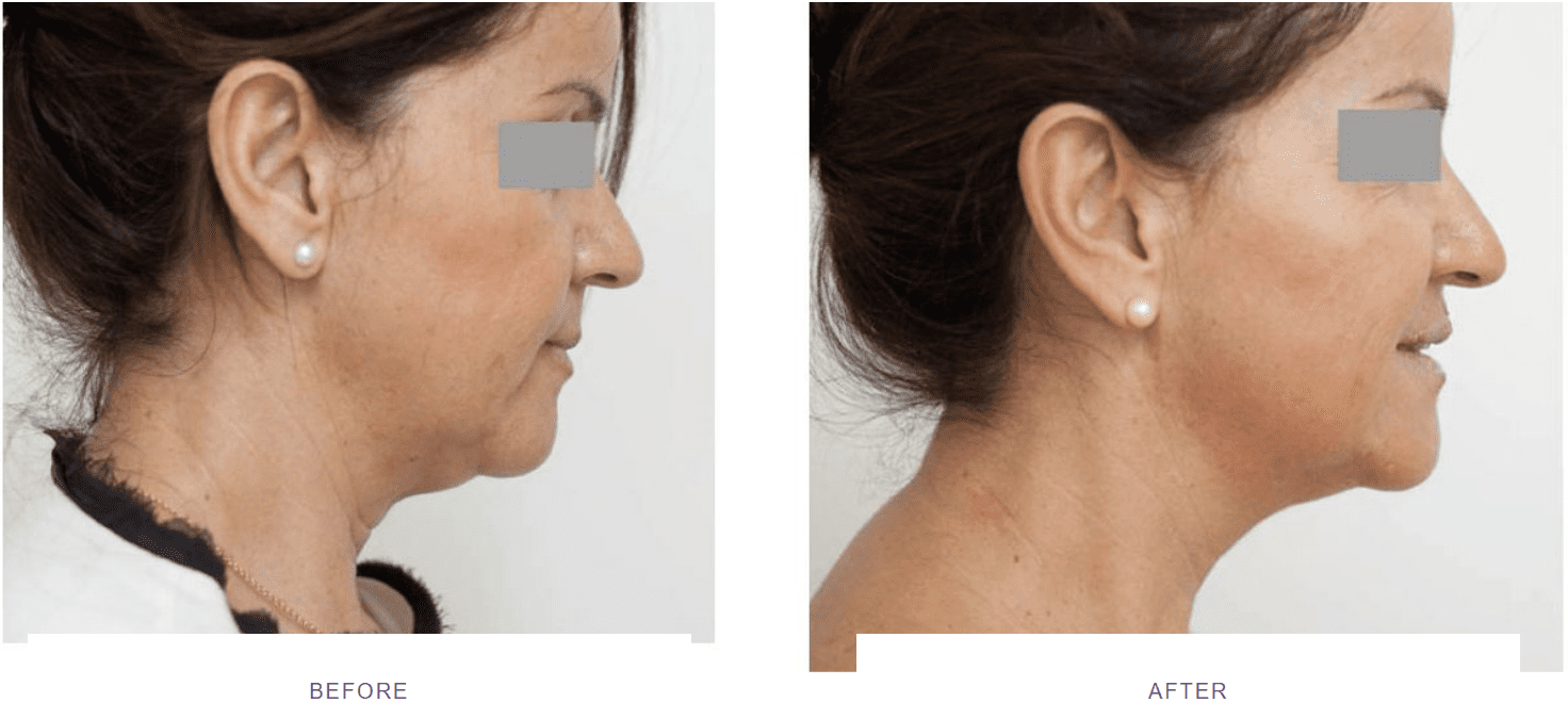 profhilo neck lift before after