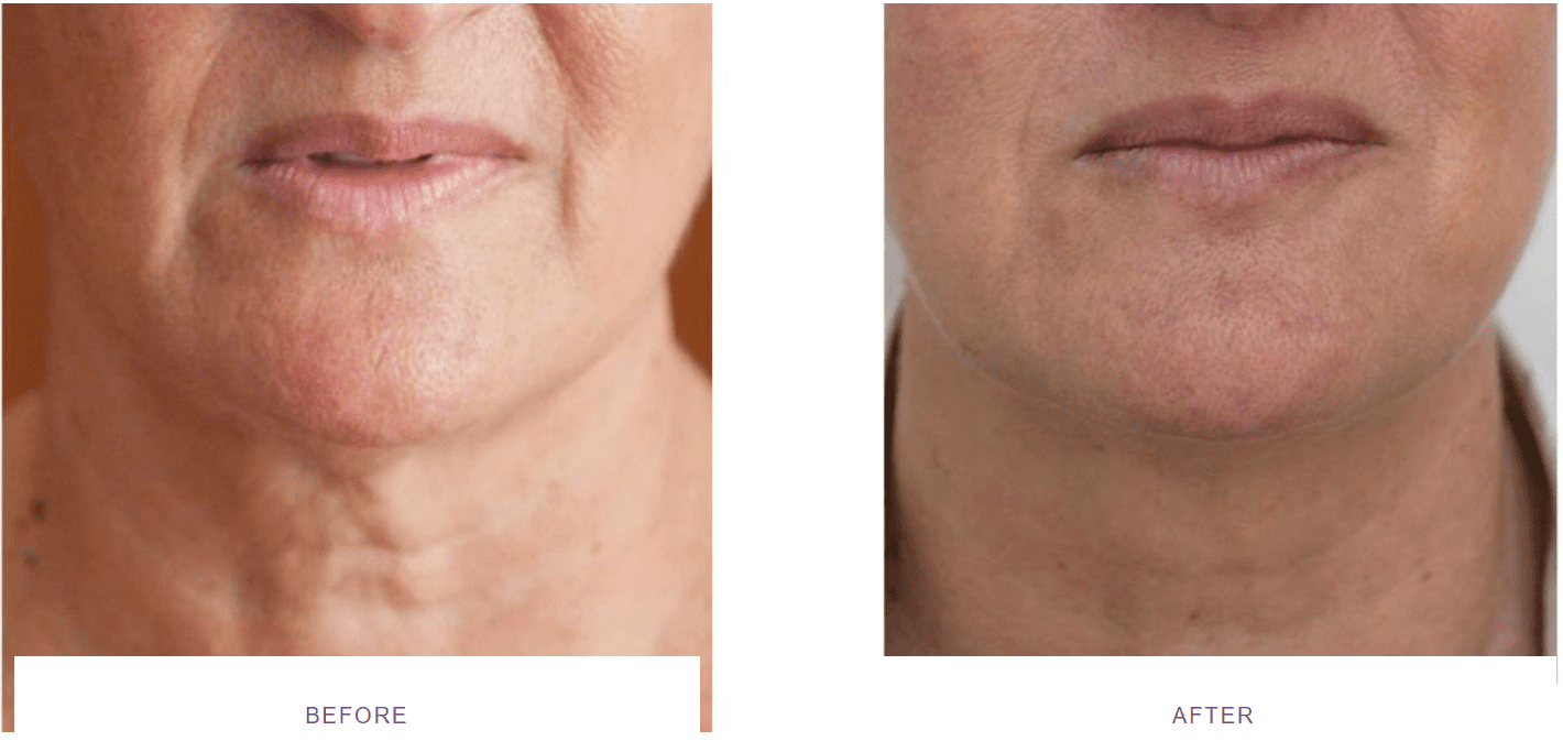Profhilo to neck area before and after