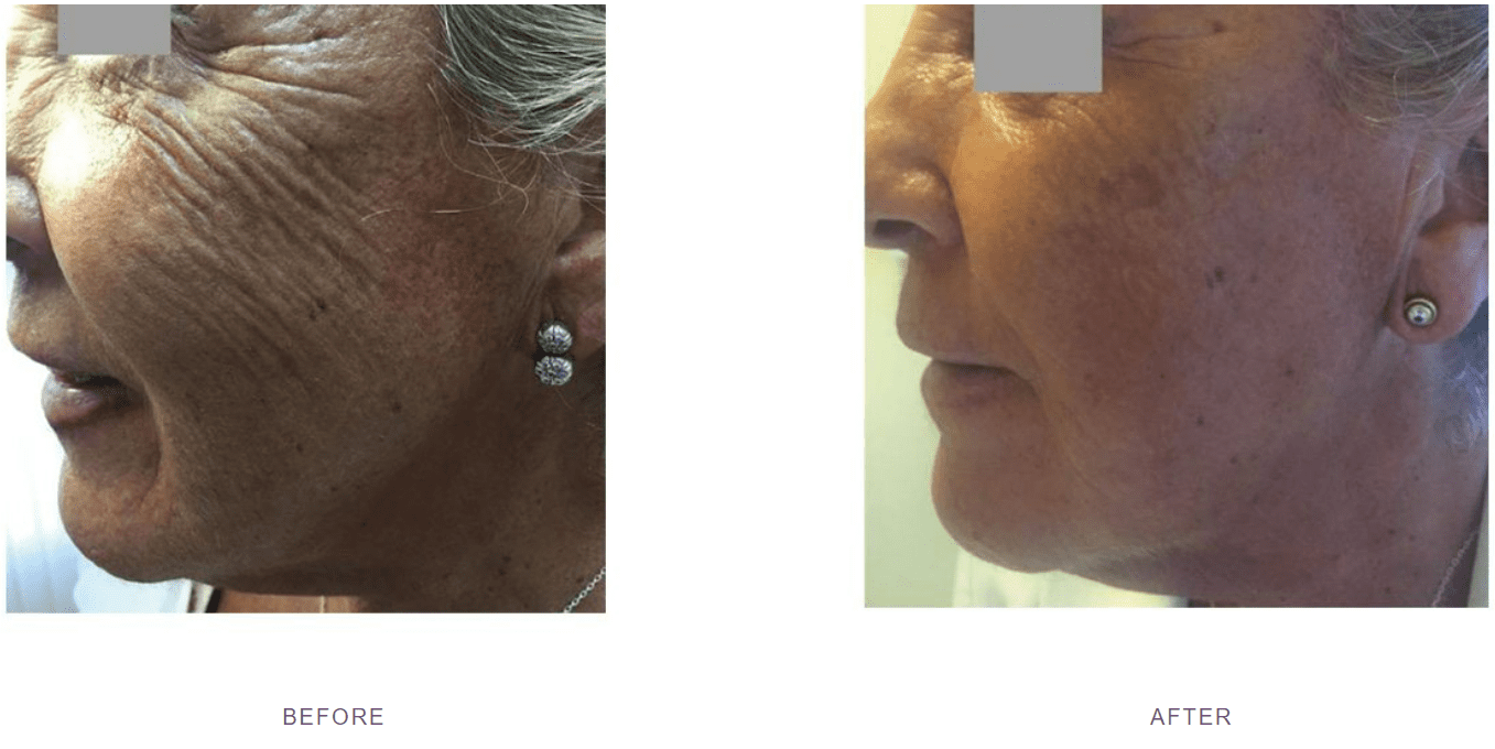 profhilo face skin tightening before after