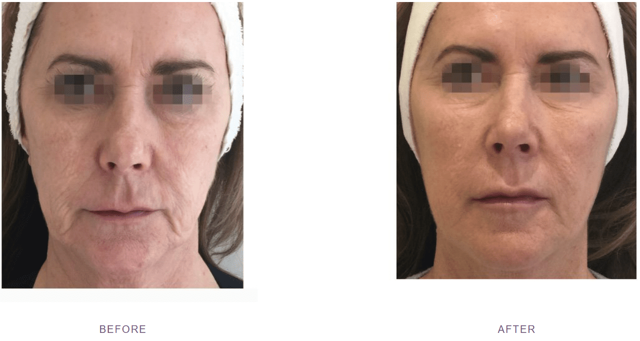 profhilo skin laxity before after