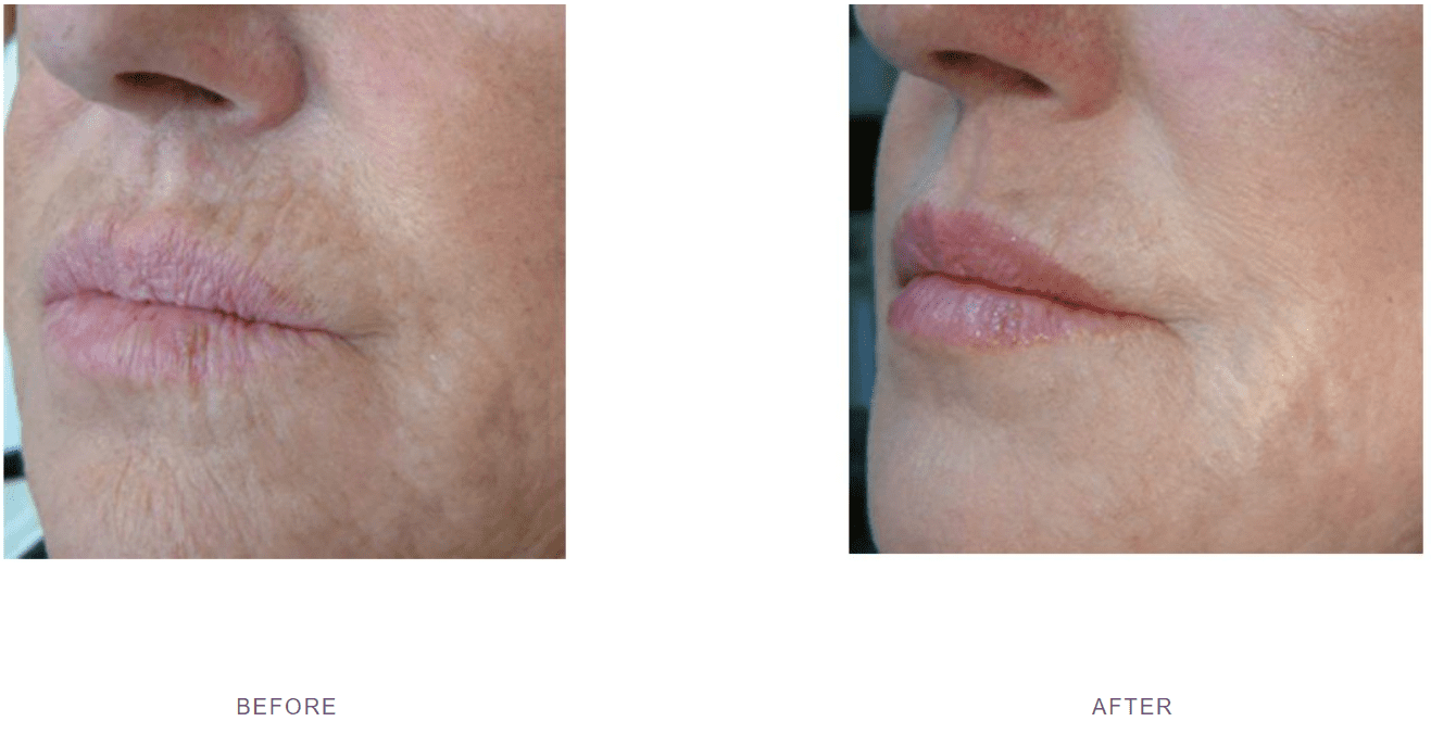 profhilo smokers lines mouth wrinkles before after