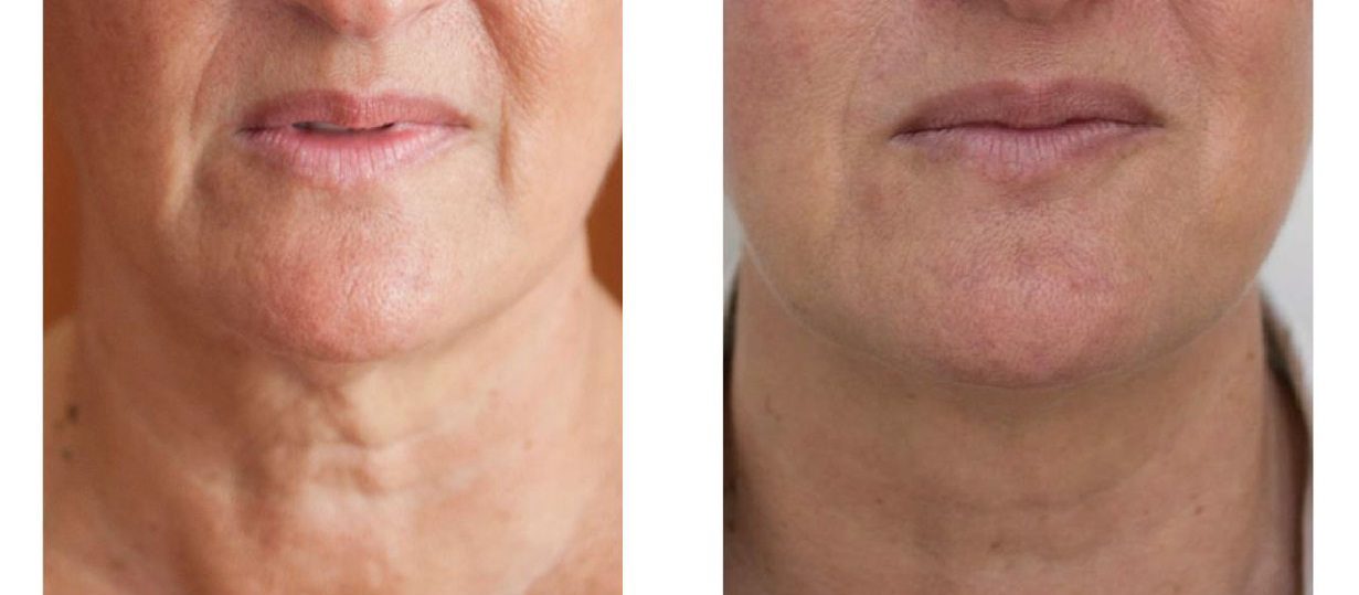 Profhilo neck before and after results