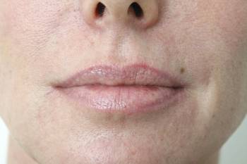 RT After Restylane Lower Face