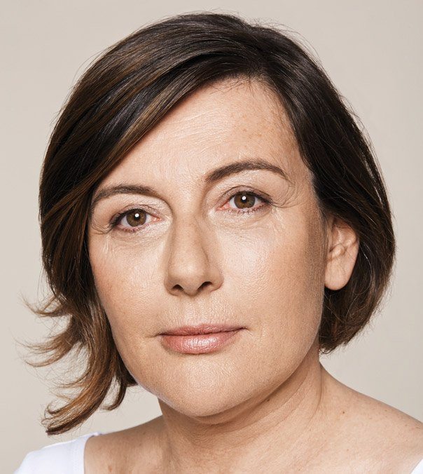 A lady after having Restylane to the cheeks, nasolabial folds and marionette lines