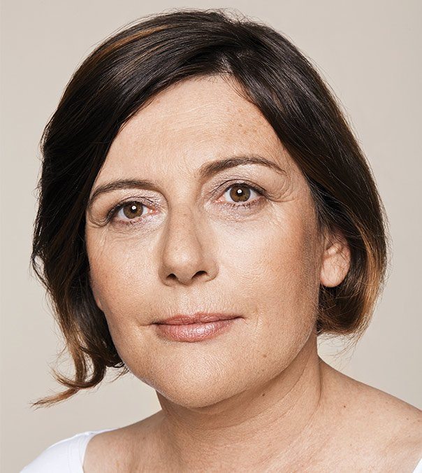 A lady with marionette lines and nasolabial folds, before having Restylane treatment