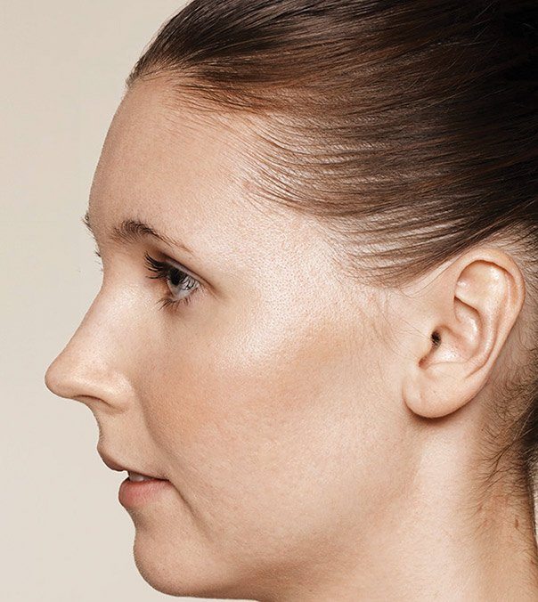 A female face following treatment for acne scarring