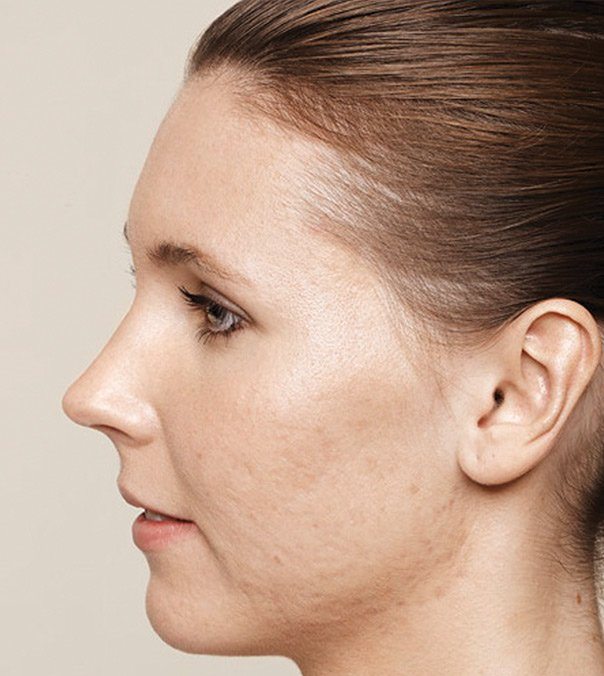 A female face before receiving treatment for acne scarring