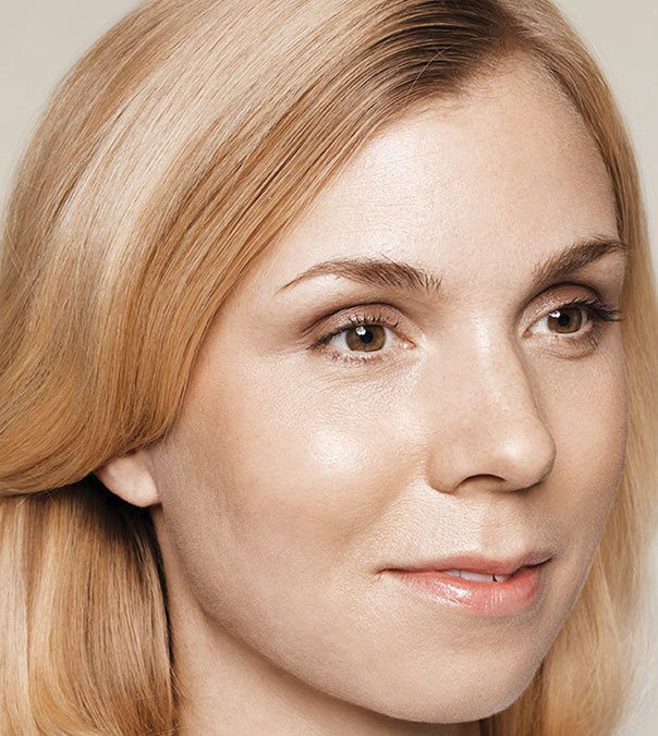 A lady who has has Restylane Skinboosters treatment for acne scarring