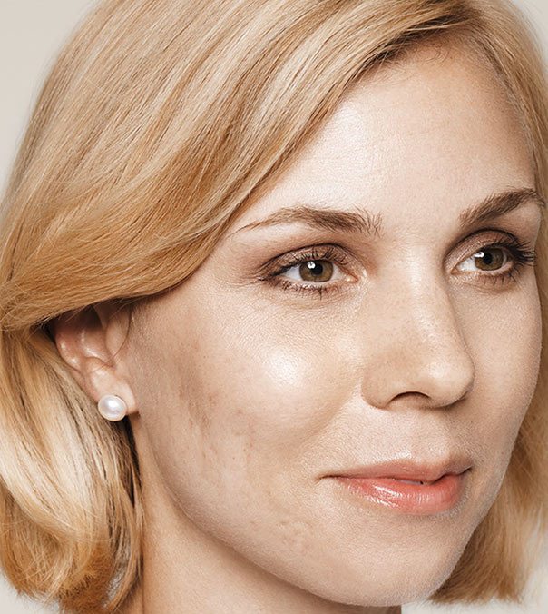 A lady with acne scarring before undergoing Restylane Skinboosters treatment