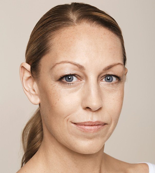 A lady before having lip line, tear trough, lower cheek and forehead treatment