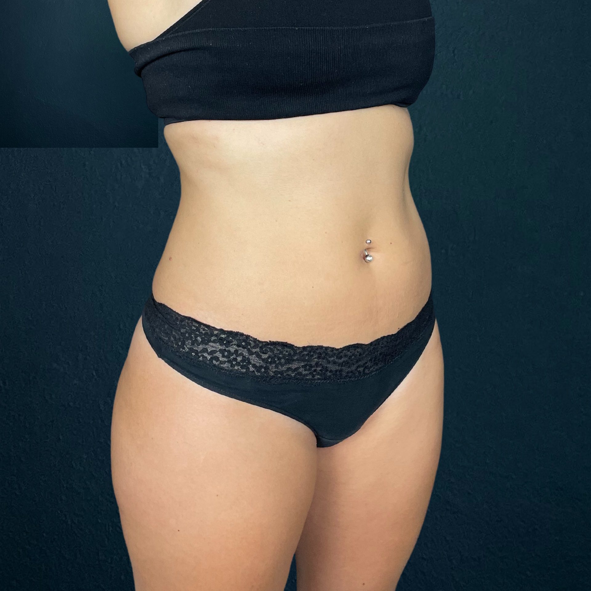 emsculpt neo abs, emsculpt neo abs muscles after