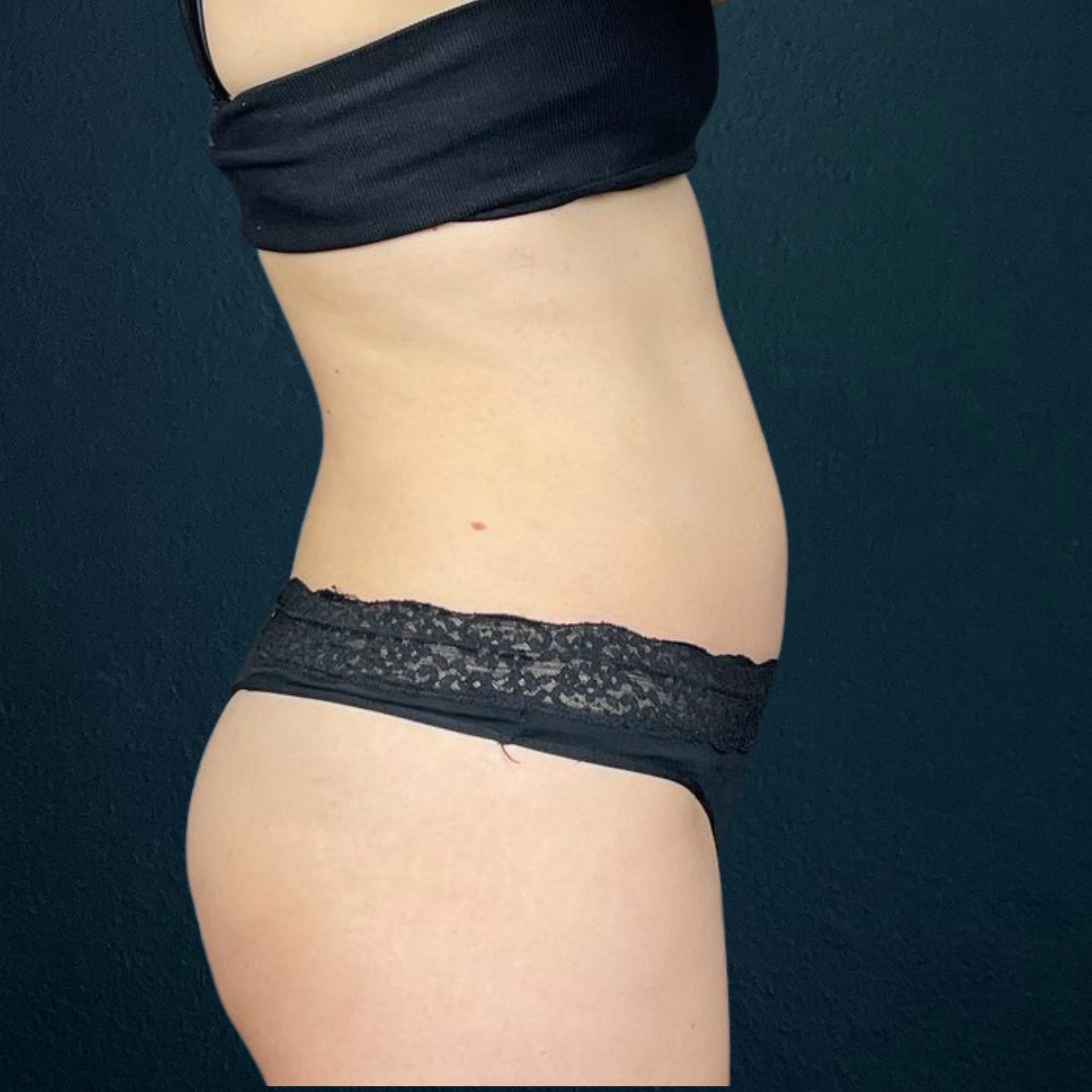 emsculpt neo on abdomen before treatment