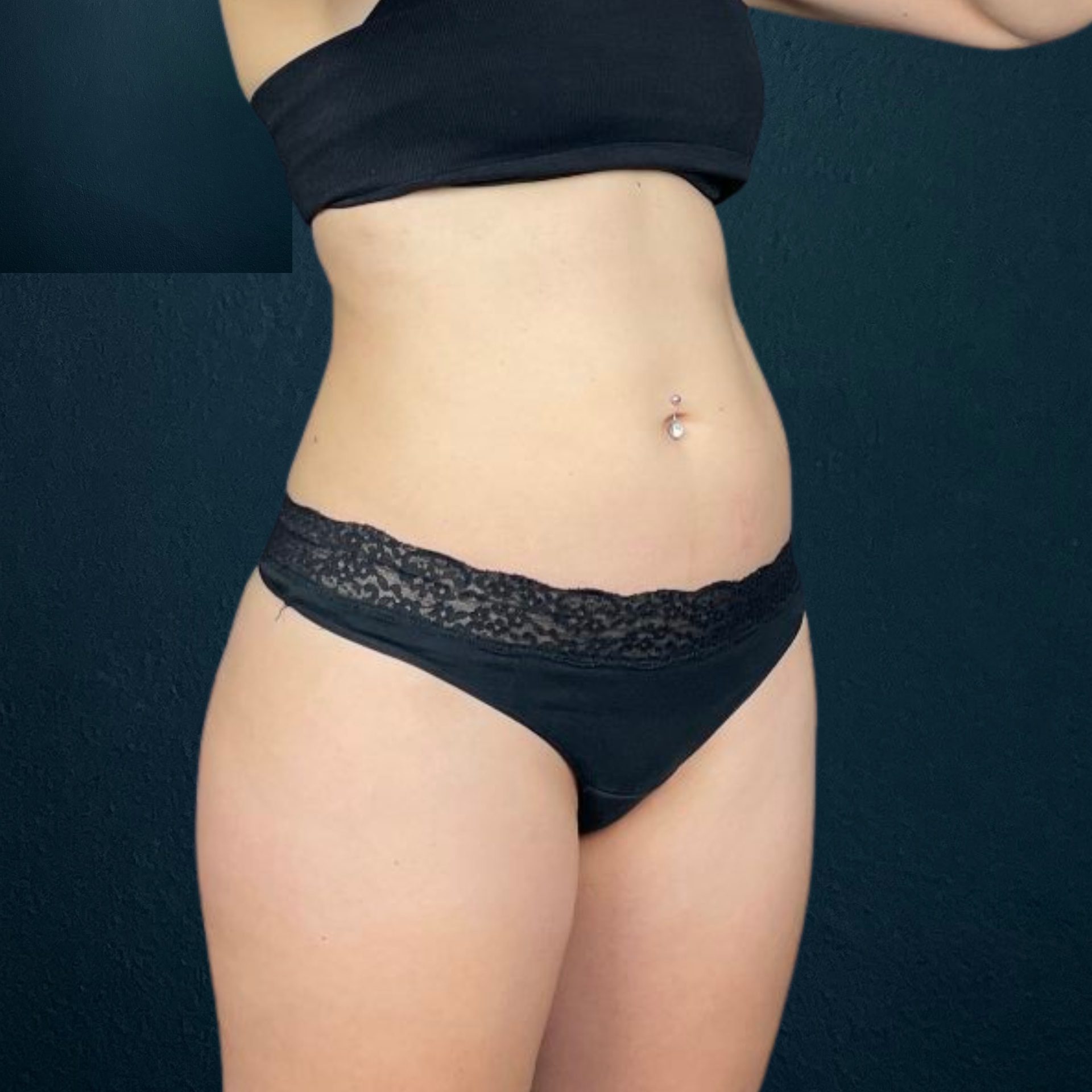 emsculpt neo on stomach before, build muscle burn fat on belly