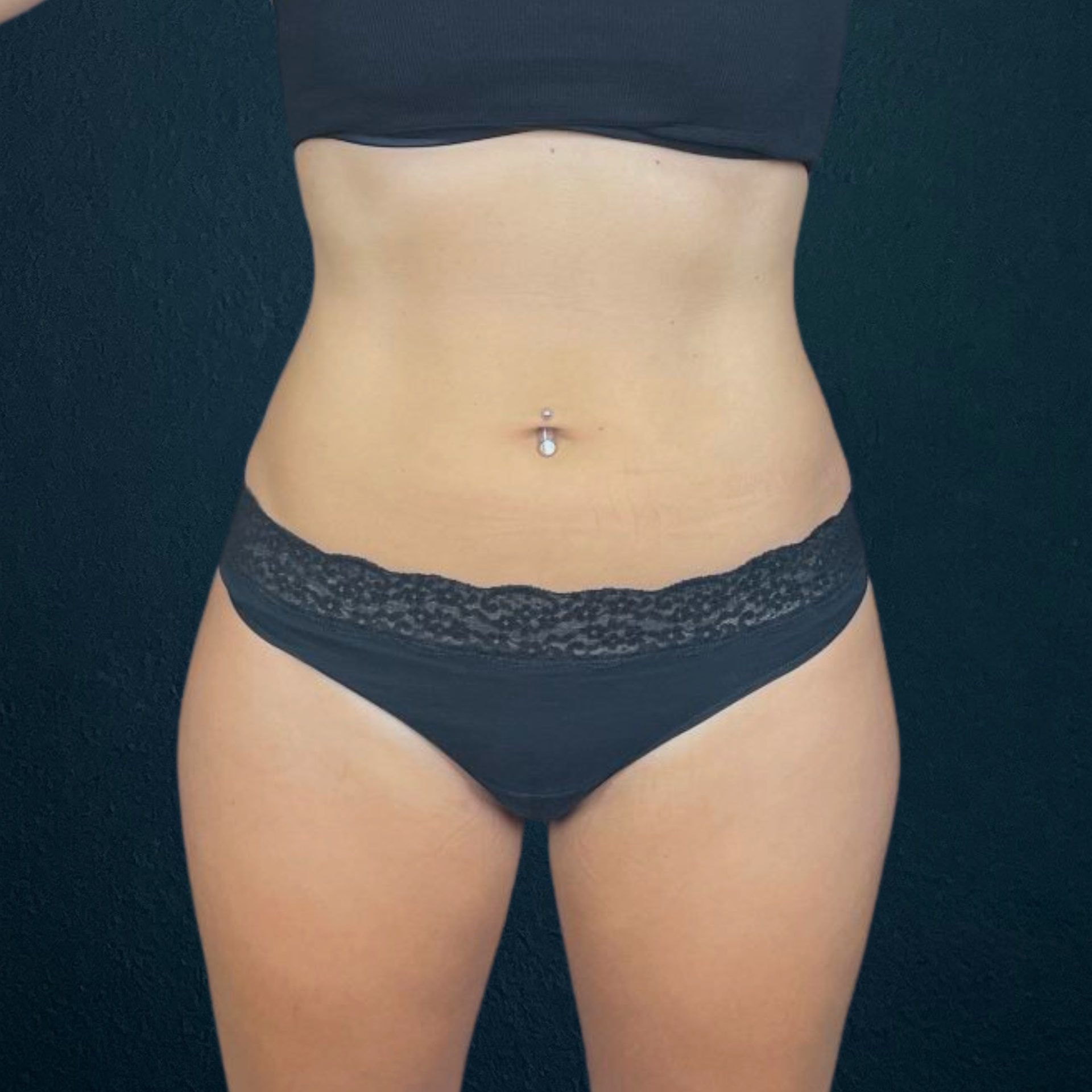 emsculpt neo before, before emsculpt neo abdomen