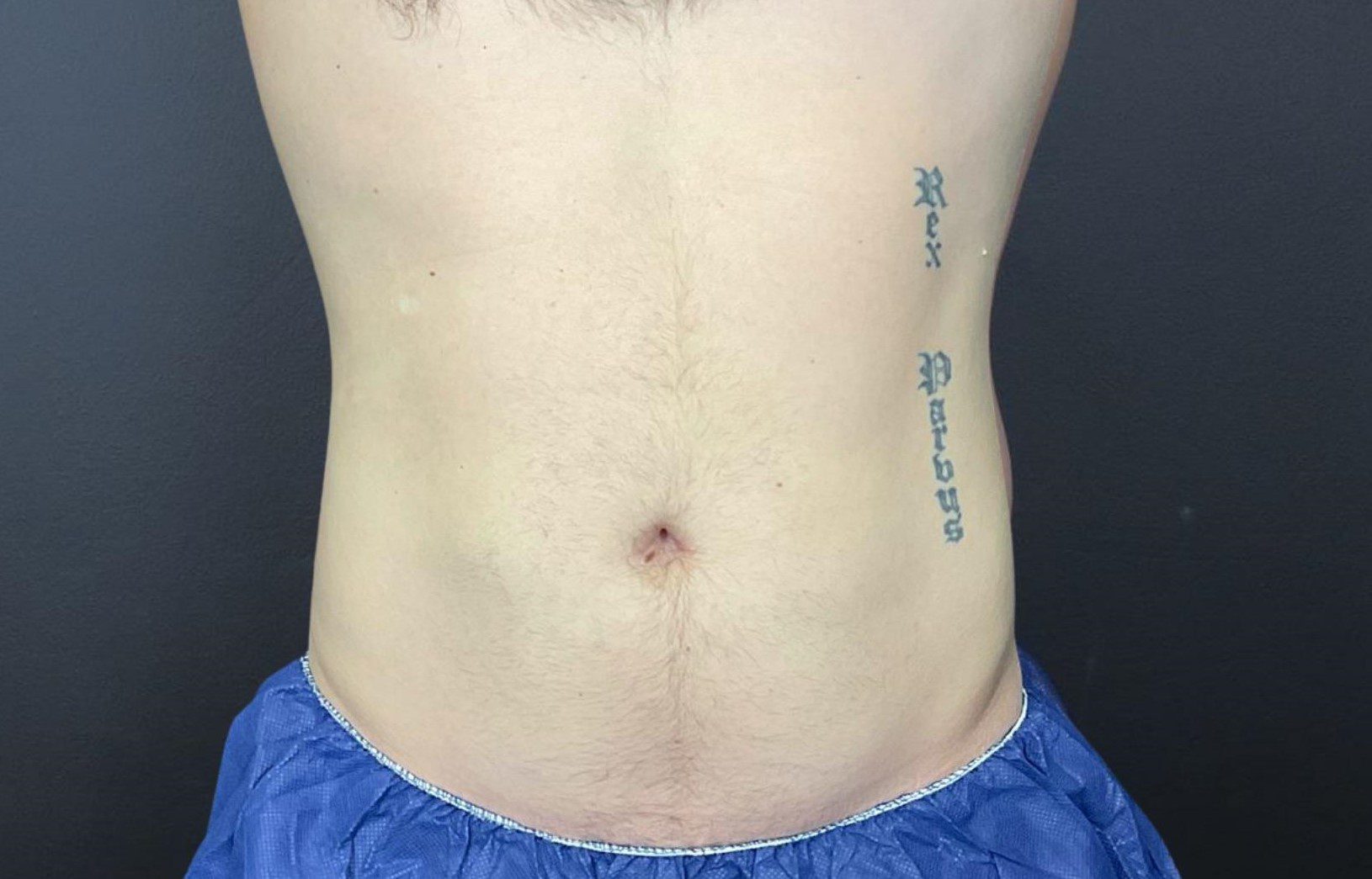 coolsculpting belly fat after - male patient
