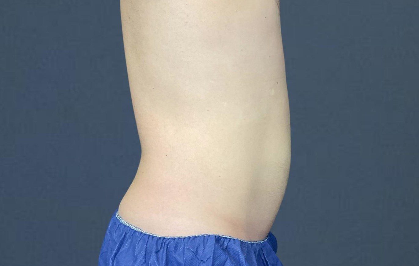 coolsculpting belly fat, flanks side profile after