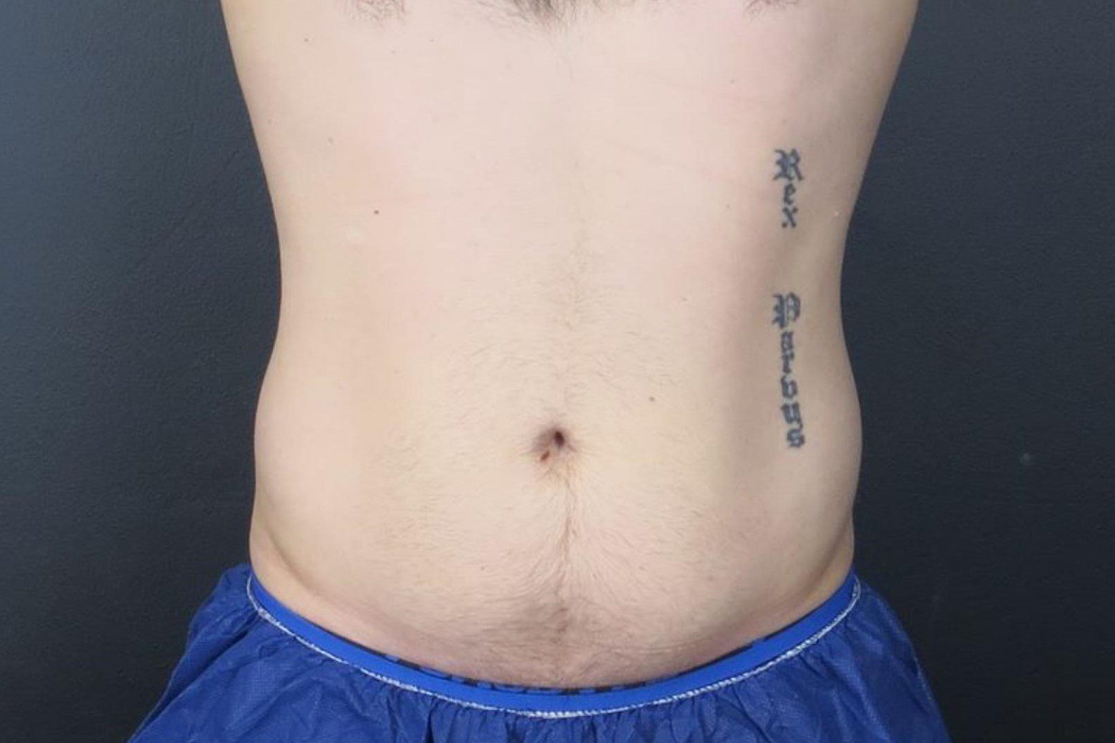 coolsculpting belly fat before