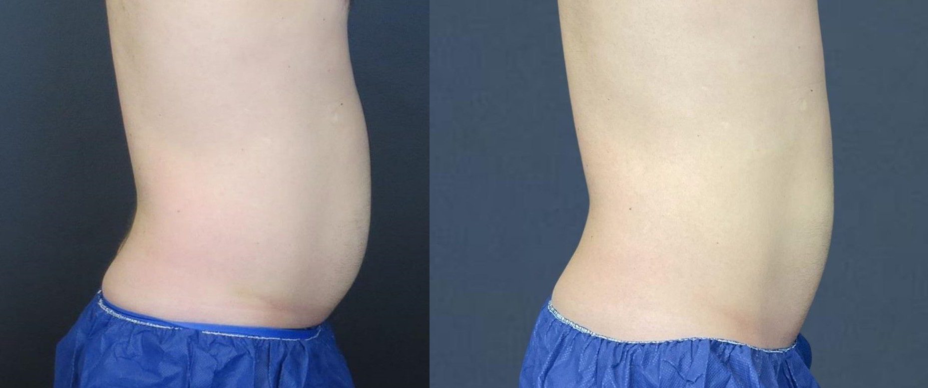 coolsculpting before and after abdomen fat freezing