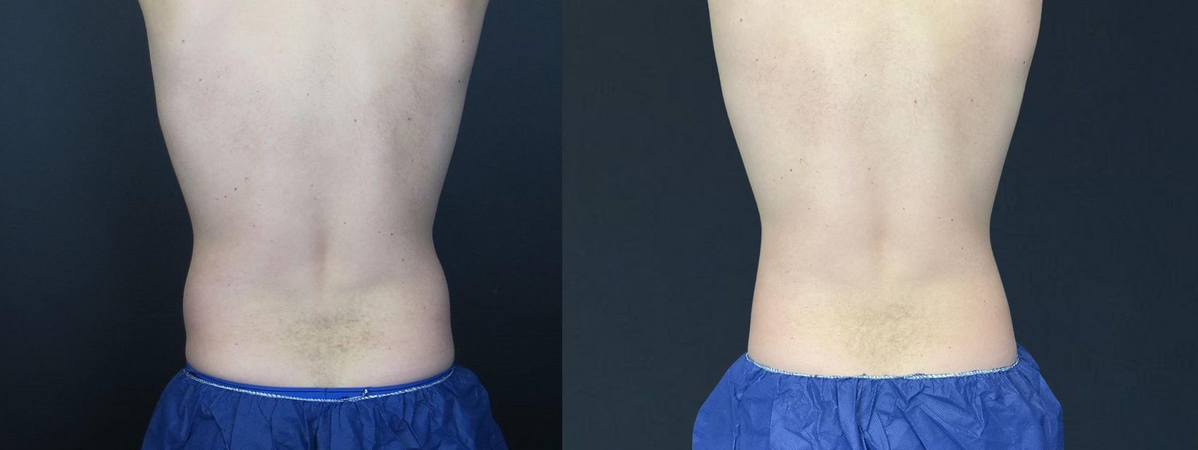 coolsculpting before and after flanks