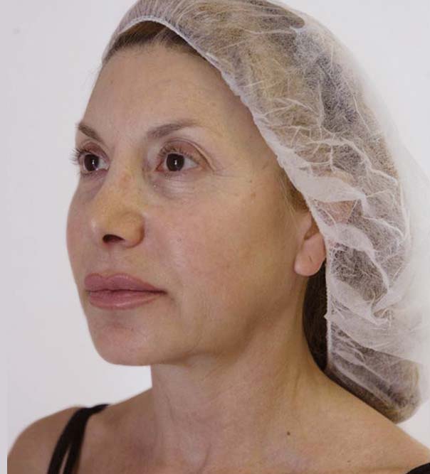 A lady before treatment with thread lifts