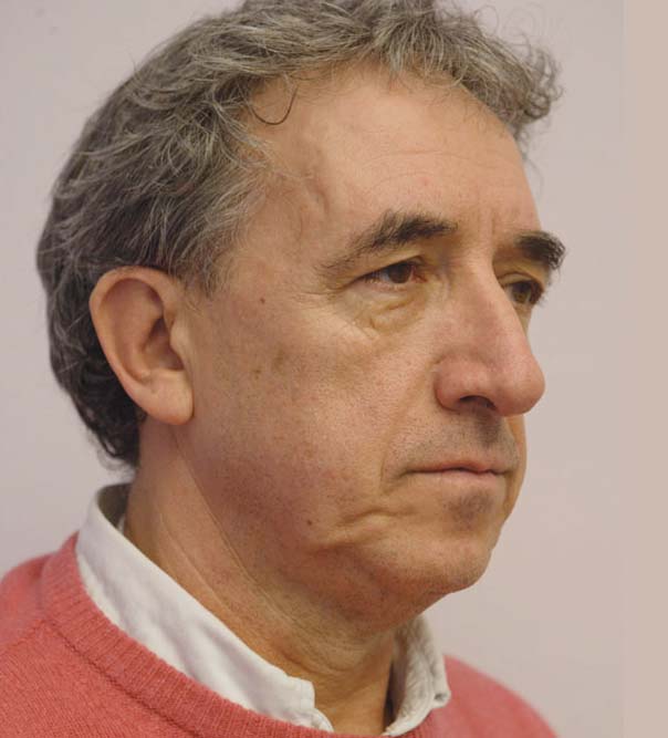 A man prior to having Silhouette Soft thread lift treatment