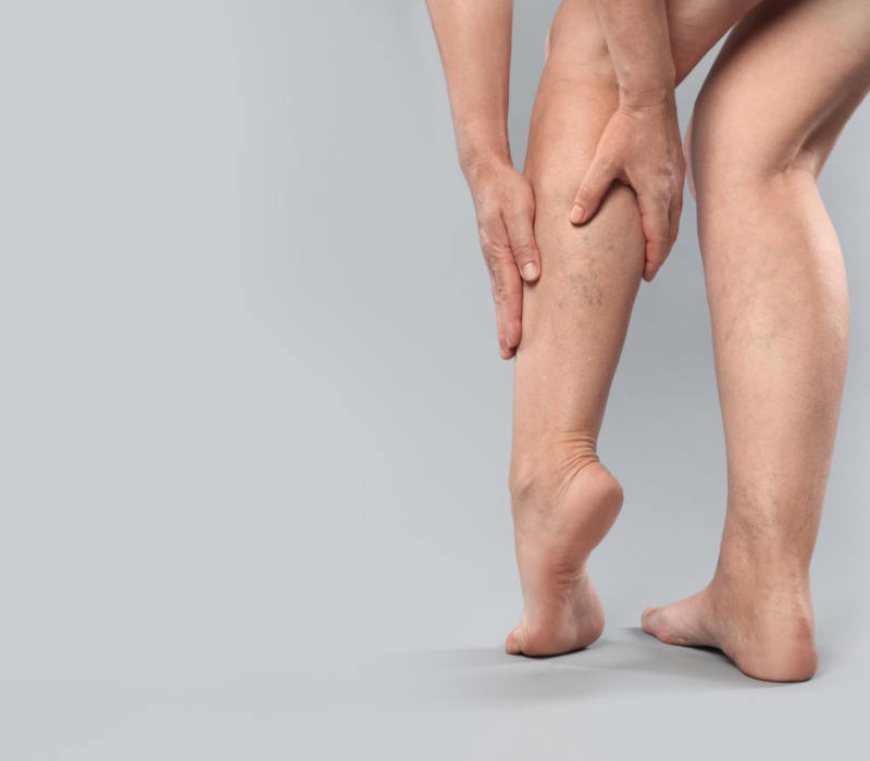 Sclerotherapy Treatment