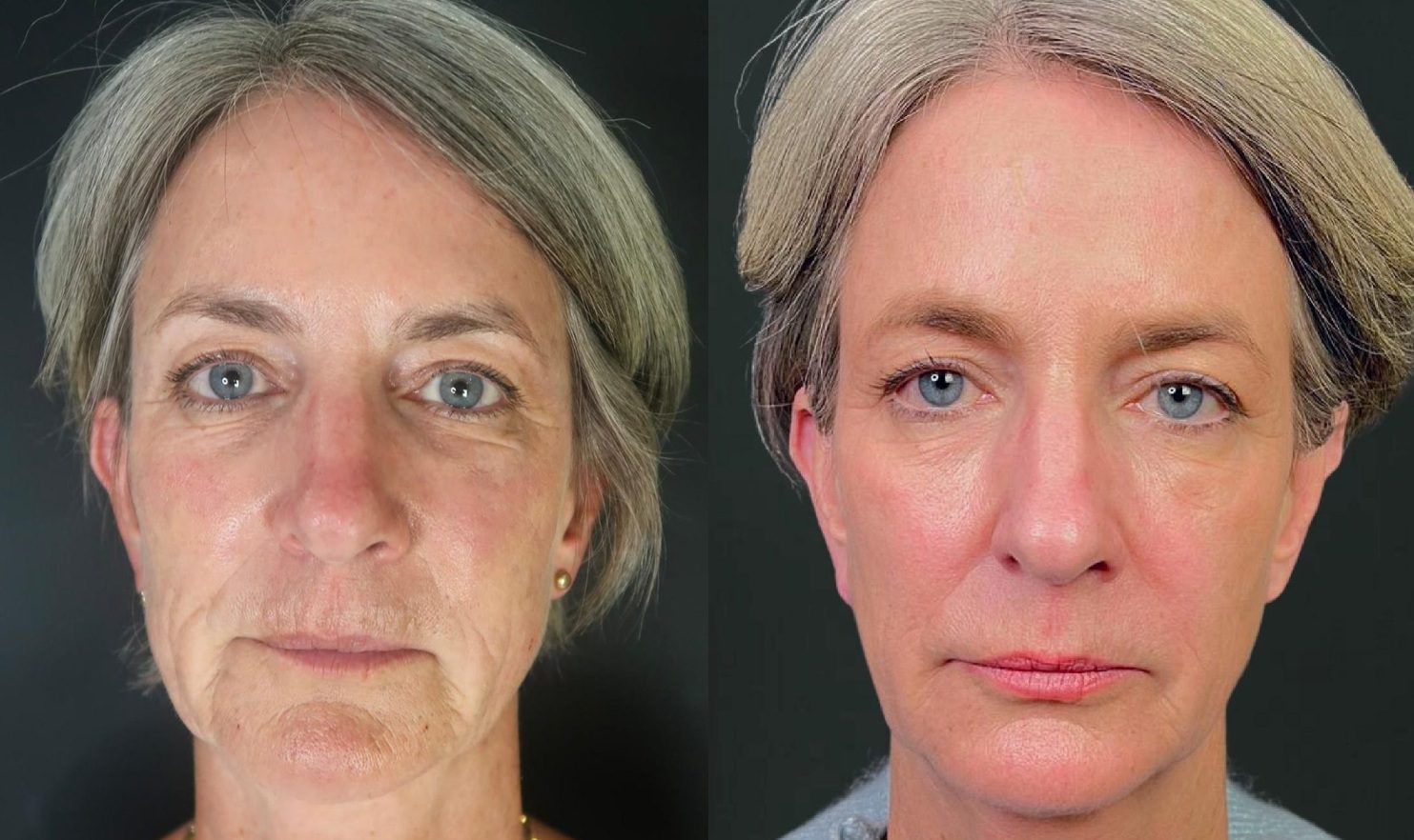 Sculptra face before and after results