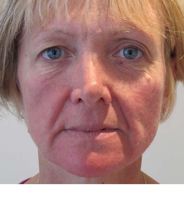 Sculptra thread lifting before