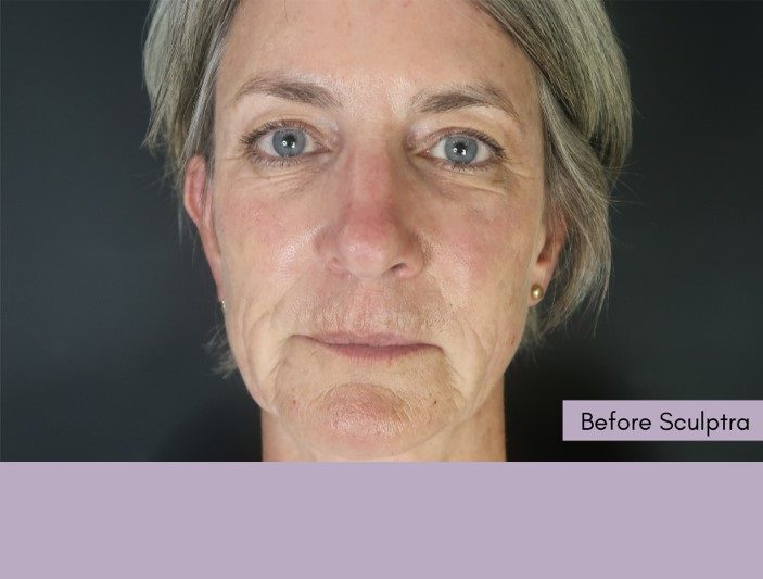 Sculptra treatment for wrinkles before