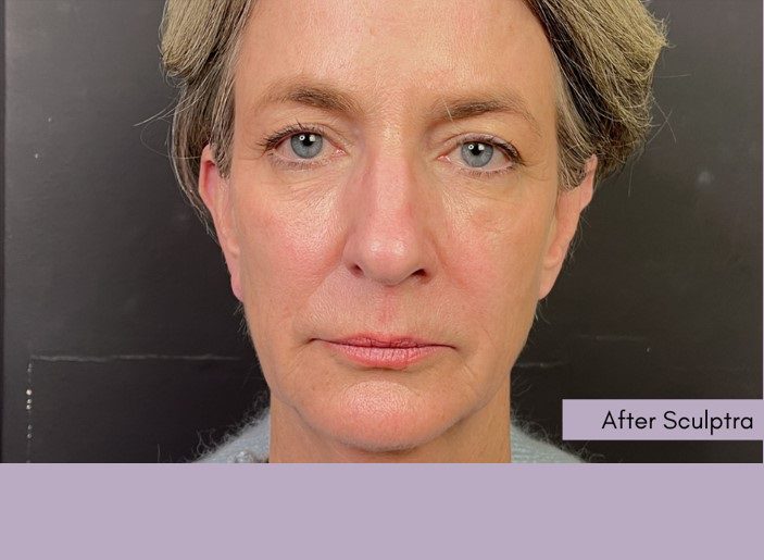Sculptra wrinkles and fine lines treatment after