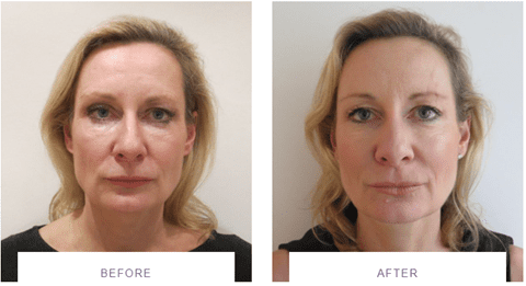 jawline and midface silhouette soft thread lift before and after