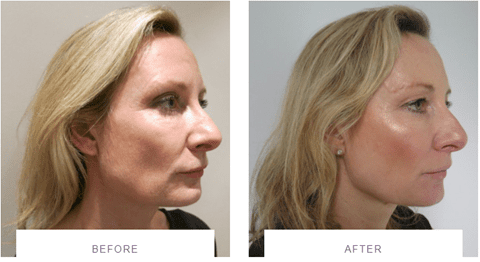 Silhouette Soft Thread Lift before and after