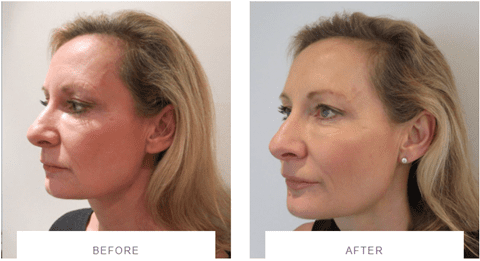 midface silhouette soft thread lift before and after