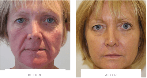 silhouette soft thread lift before and after jawline and mid-face