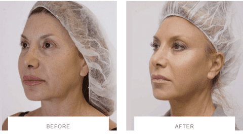 Silhouette Soft Thread Lifts to tighten and lift the jawline and the mid-face before and after