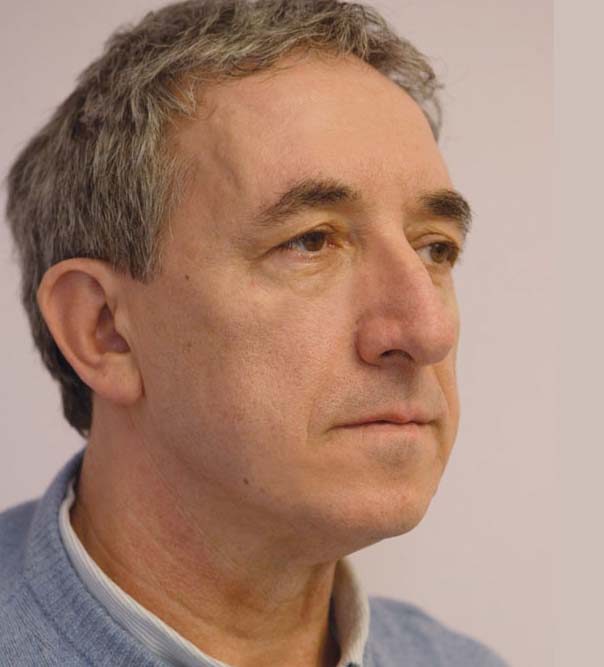 Silhouette Soft Thread Lift Skin Tightening man after