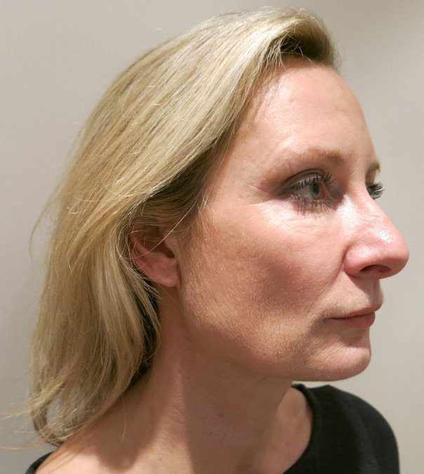 Silhouette Soft Thread Lift side Before