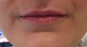 Small Skinny Lips Fillers After