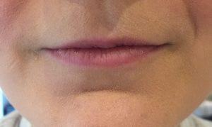 Small Skinny Lips Fillers Before