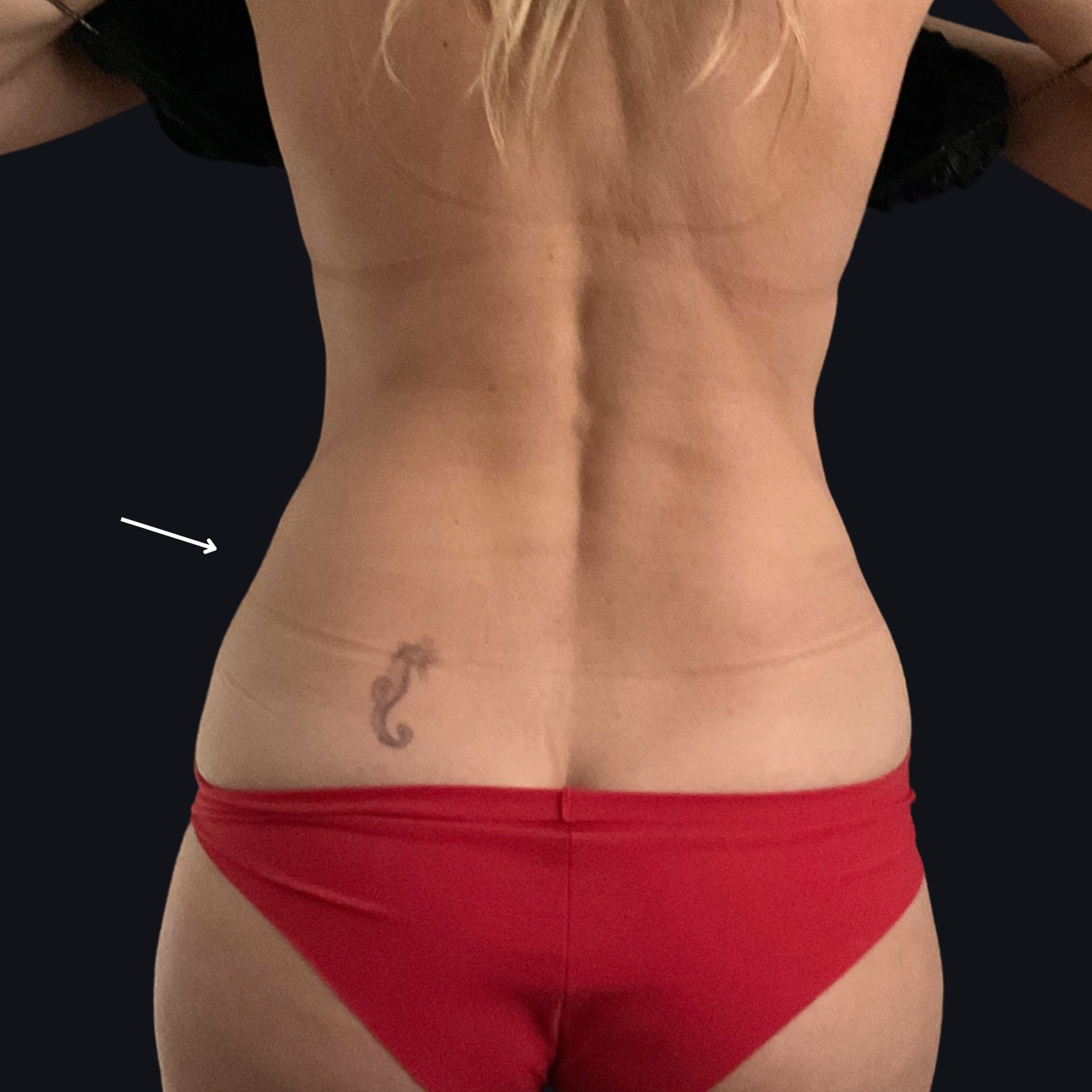 Smooth Sculpt - CoolSculpting Back After By Ria Murch