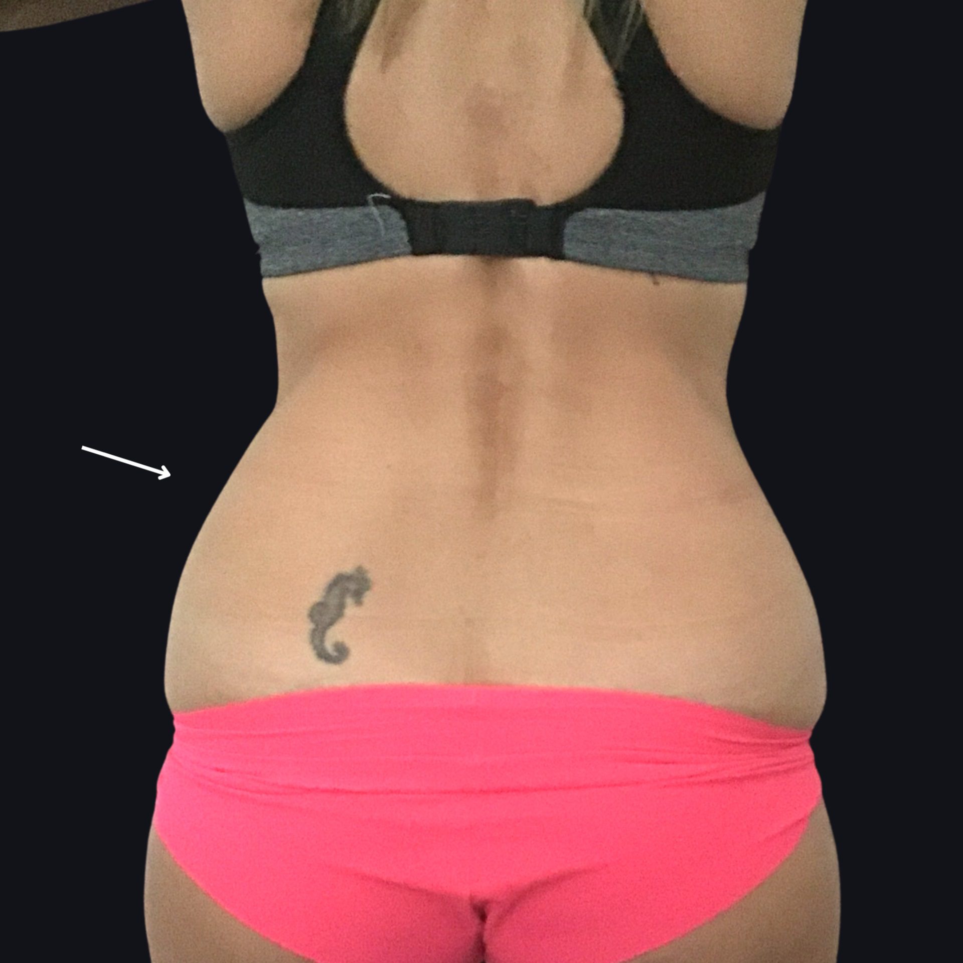 Smooth Sculpt - CoolSculpting Back Before By Ria Murch