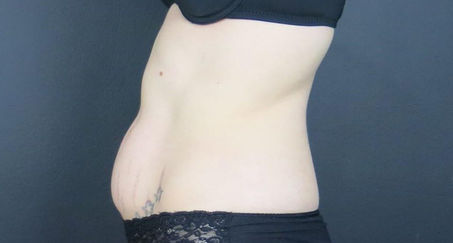 coolsculpting belly fat, mummy tummy before