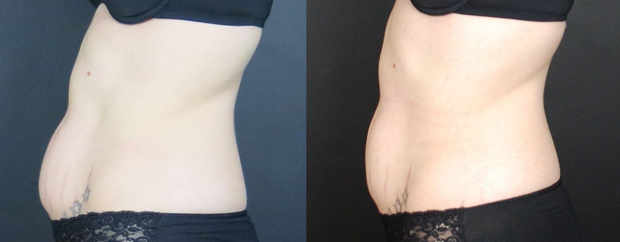 coolsculpting mummy tummy before and after