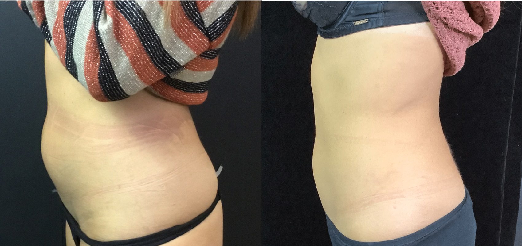 Stomach fat CoolSculpting Fat Freezing Before and After - Magda