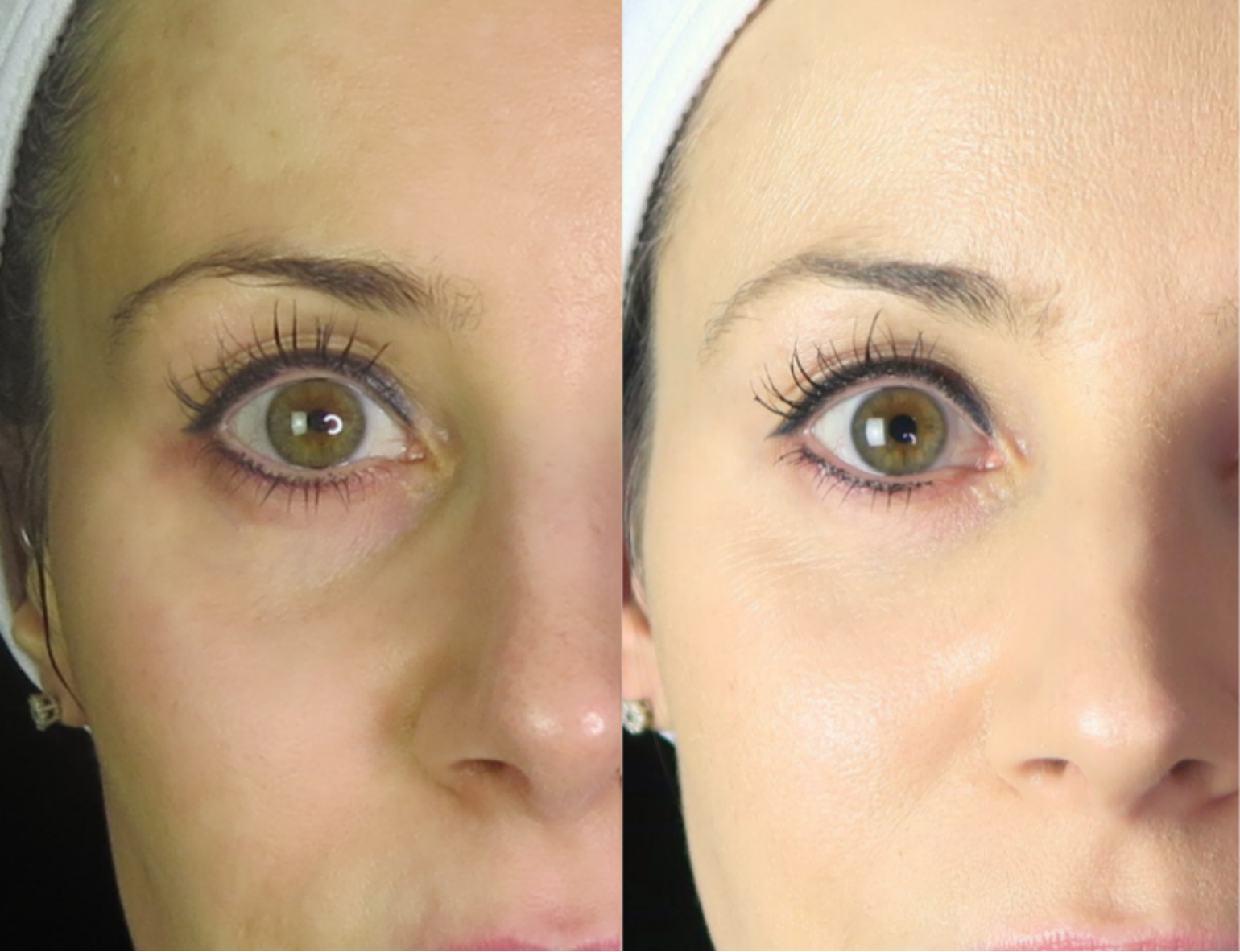 Tear Trough Dermal Filler