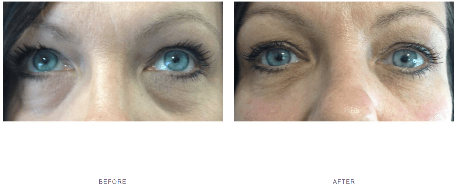 dark circles under eyes filler before after