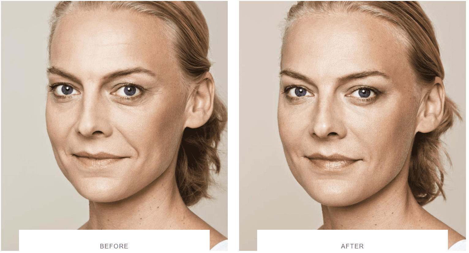 under eye bags fillers before after